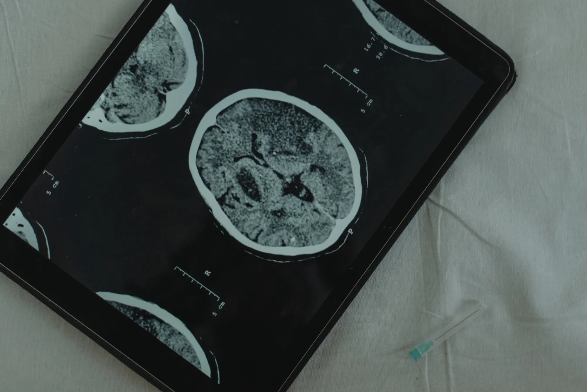 Neurology Advances in Care and Treatment